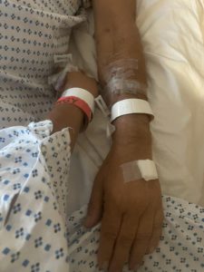 Hospital patient lying in bed with an IV in the arm and taped dressings on the forearm.